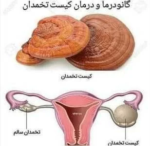 قهوه گانودرما برای فیبروم نی نی سایت