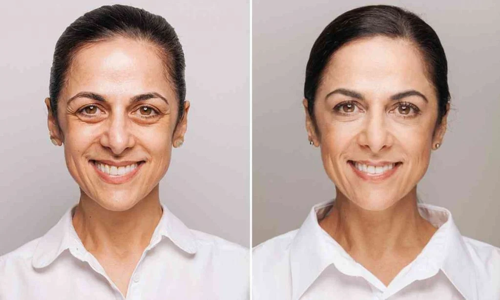  کرم بوتاکس برای صورت؛ راهی برای جلوگیری از پیر شدن پوست
