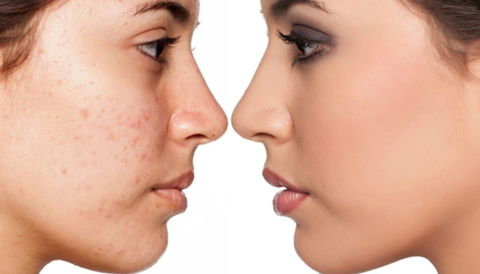 پوست کرم ترمیم کننده صورت برای پوست های چرب