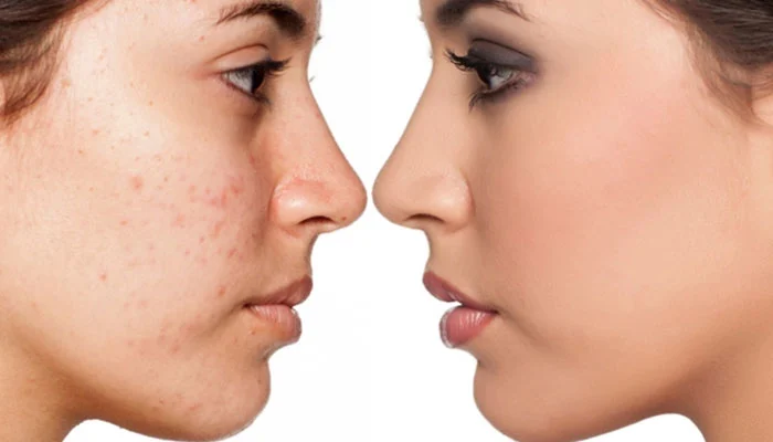 کرم ترمیم کننده صورت برای پوست های چرب