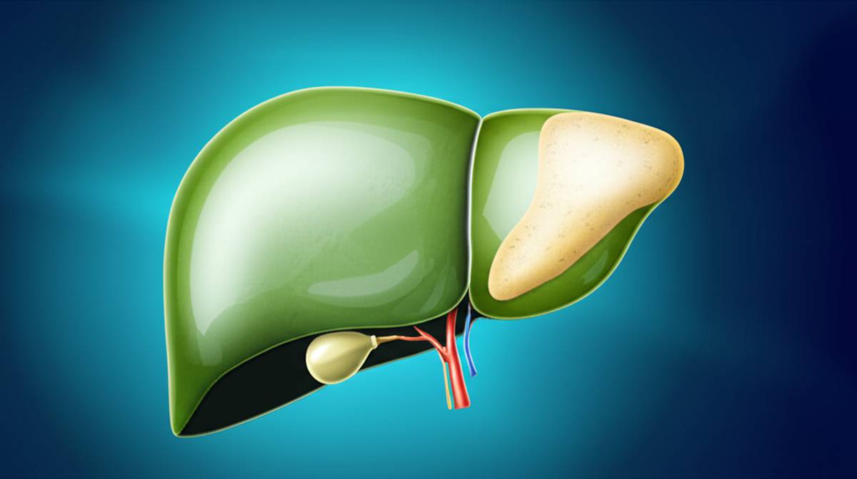 خلاصه کتاب راهنمای جامع کبد چرب اثر سید موید علویان