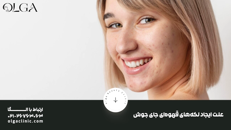لیزر فوتونا: راهکاری مدرن برای از بین بردن لکه های قهوه ای جای جوش